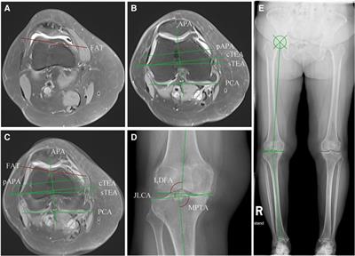 The femoral anterior tangent line could serve as a reliable alternative reference axis for distal femoral rotational alignment in total knee arthroplasty: an MRI-based study
